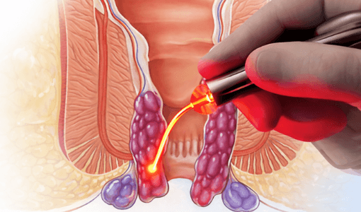 Best Piles, Fissure & Fistula Hospital Aundh